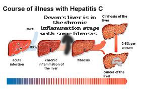 New Hepatitis C Treatment - Week 20: Milestone - Hep